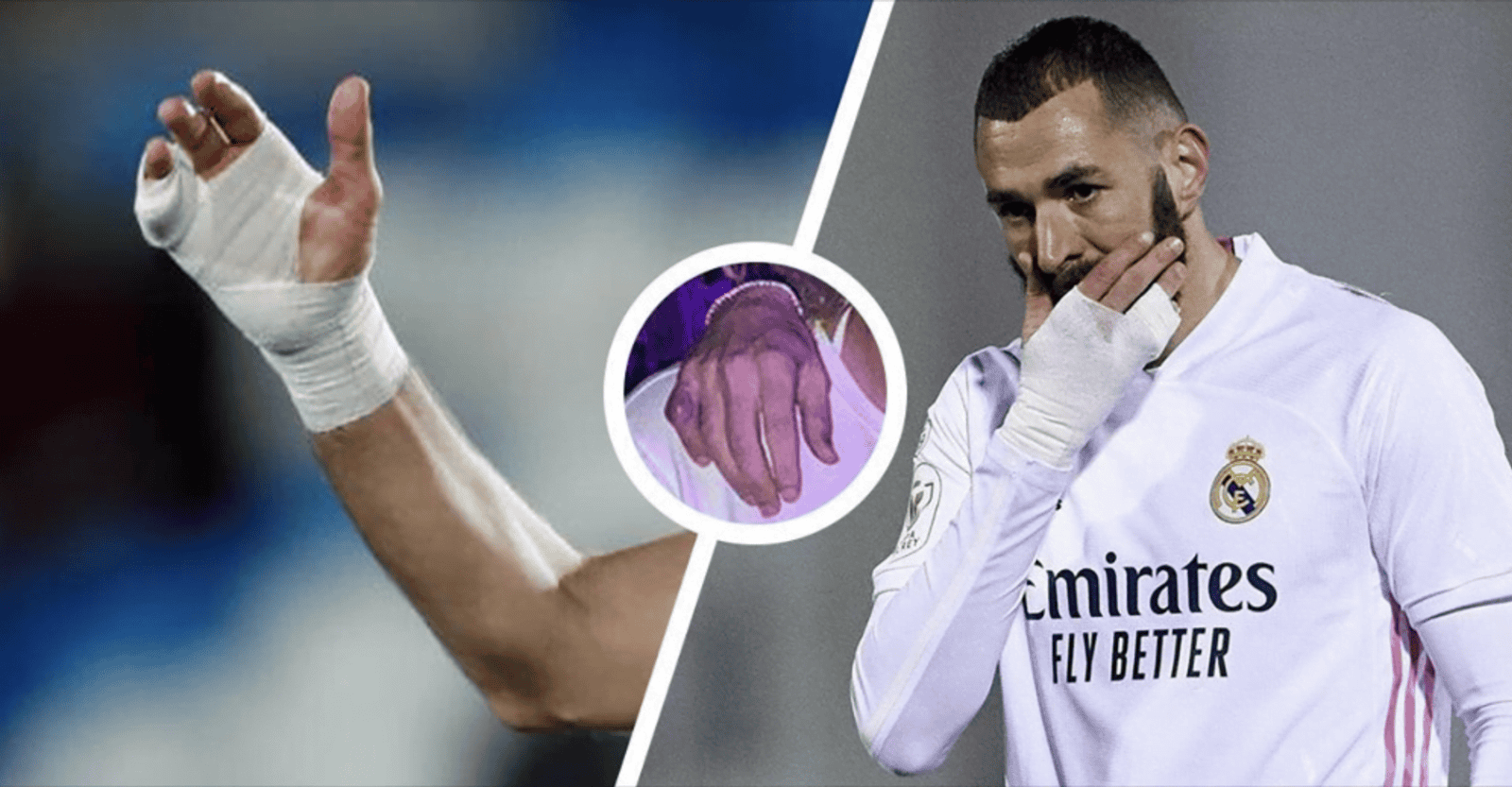 Benzema’s bandaged hand’s real story